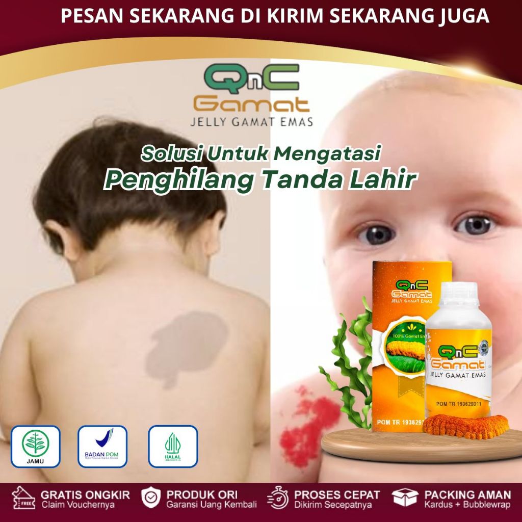 Obat Penghilang Tanda Lahir Hemangioma, Tanda Lahir Merah Menonjol Pada Bayi, Tanda Lahir Hitam Coke