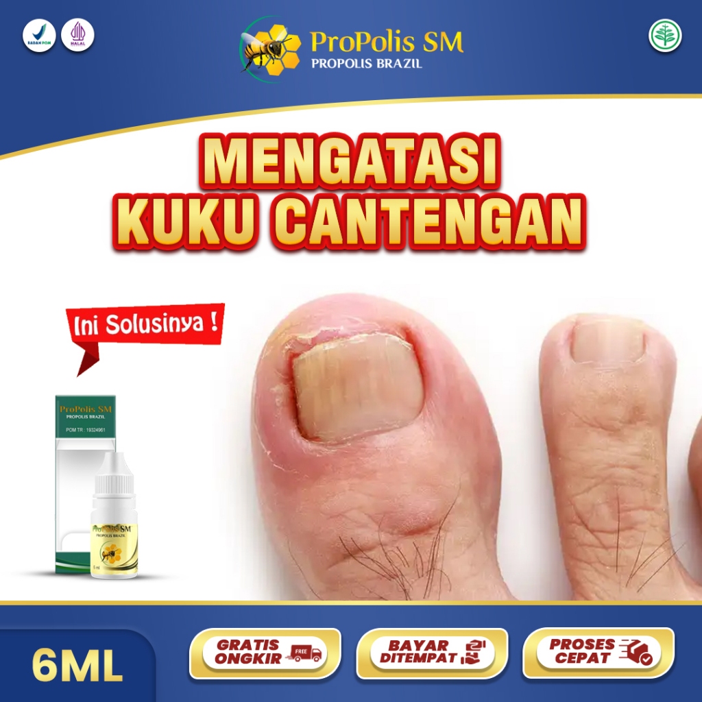 Obat Kuku Cantengan Jempol Kaki Bengkak Bernanah Jamuraan Kutu Air Kapalan Propolis SM Isi 6ml BPOM