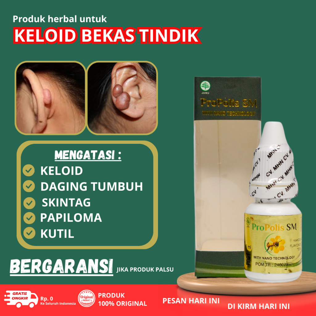 Obat Keloid Bekas Tindik , Penghilang Keloid Bekas luka di Telinga, Obat daging tumbuh di Telinga