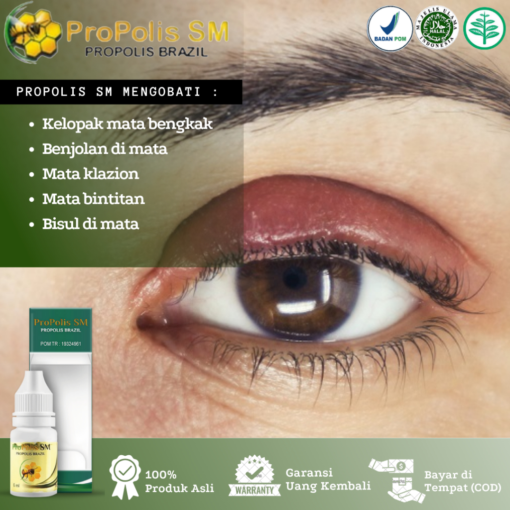 Obat Oles Kelopak Mata Bengkak, Klazion, Benjolan di Kelopak Mata, Klazion, Mata Bintitan, Bisul di 