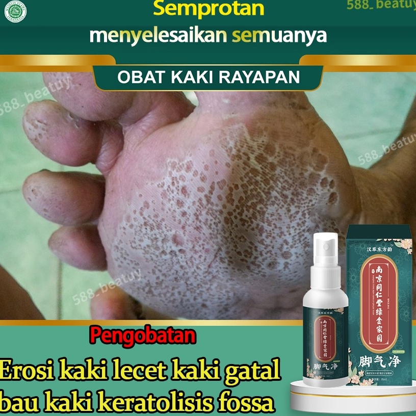 Obat Pitted Keratolysis Semprotan Spray Penghilang Anti Bau Kaki Bau Kaki Berkeringat Iritasi Kulit 