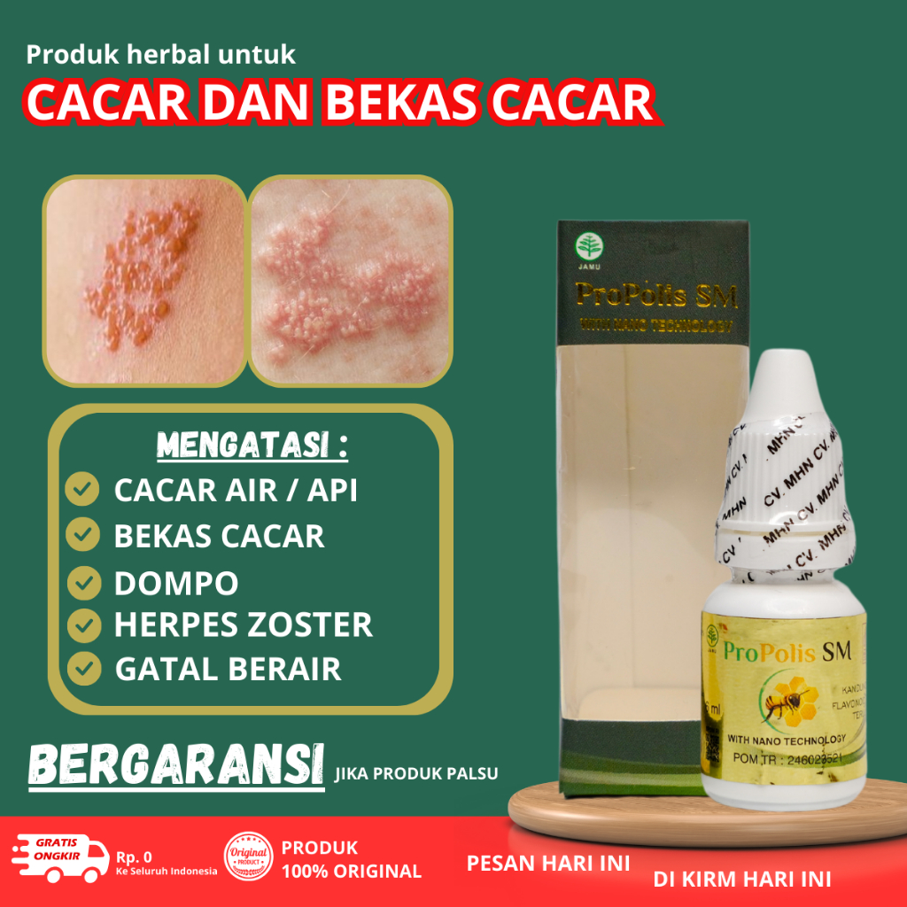Penghilang cacar air, Obat dompo anak / herpes zoster gatal berair, Obat cacar api gatal perih sakit