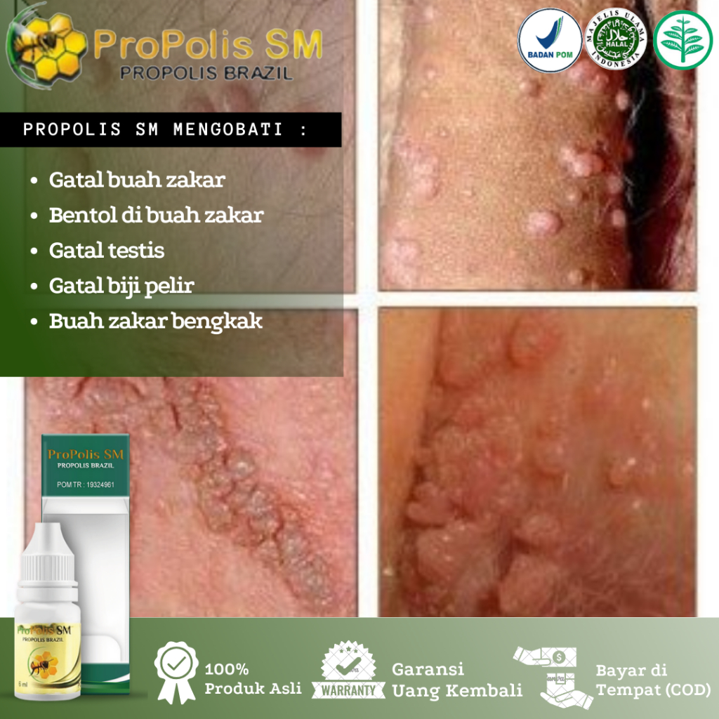 Obat Bentol di Buah Zakar, Gatal Buah Zakar, Gatal Biji Pelir, Kutu Kemaluan, Bentol Di Kantung Test