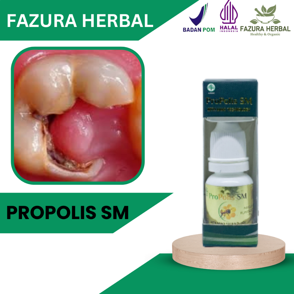 Propolis SM - Obat Polip Gigi, Obat Gigi Berlubang, Obat Sakit Gigi, Obat Abses Gigi