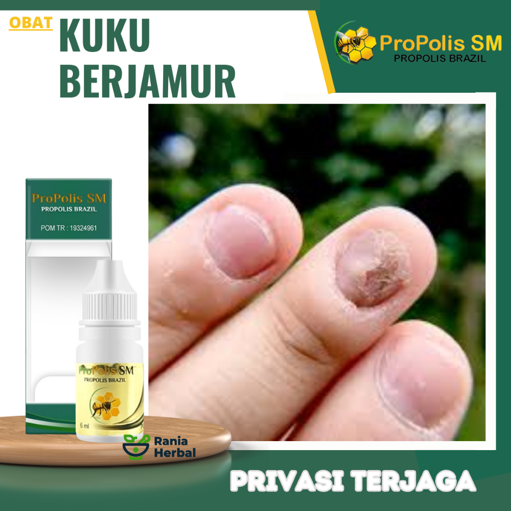 Obat Jamur Kuku, Obat Kuku Berjamur, Obat Kuku Rusak Bau, Obat Cantengan Jempol kaki Bernanah Bau In
