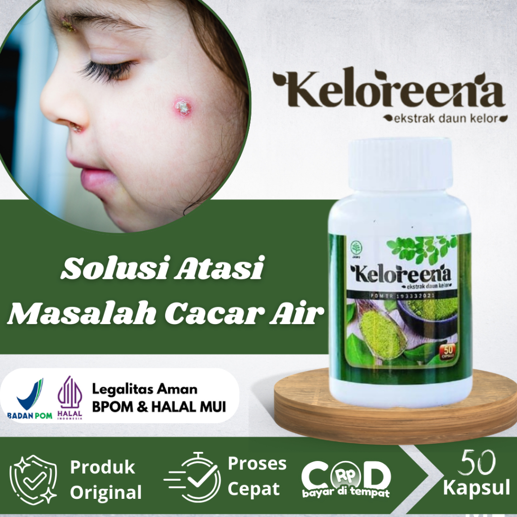 Obat Cacar Air Untuk Anak & Dewasa, Penghilang Bekas Cacar, Cacar Air Cepat Kering, Bekas Luka Cacar