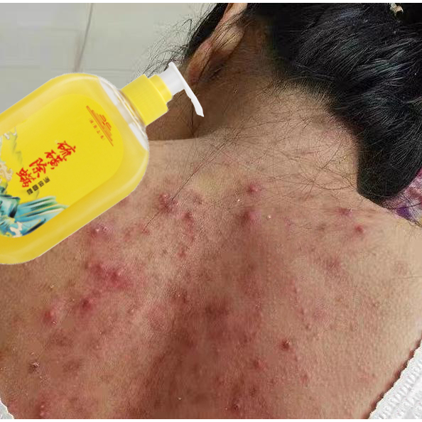 sabun jerawat punggung sabun sulfur untuk gatal acne body wash sabun sulfur untuk gatal scabies Sabu