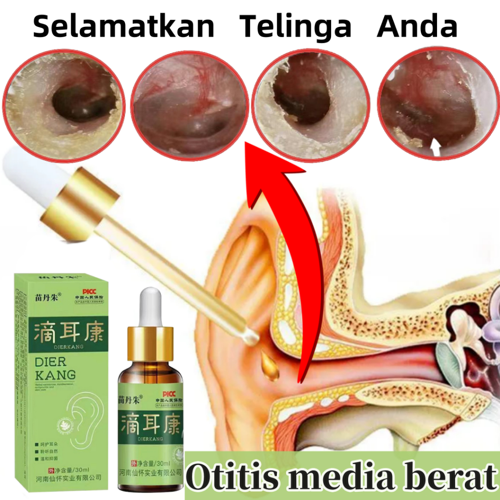 Obat Tetes telinga Obat telinga berdengung Obat telinga sakit 30ml Telinga Bernanah, Obat Telinga Tu