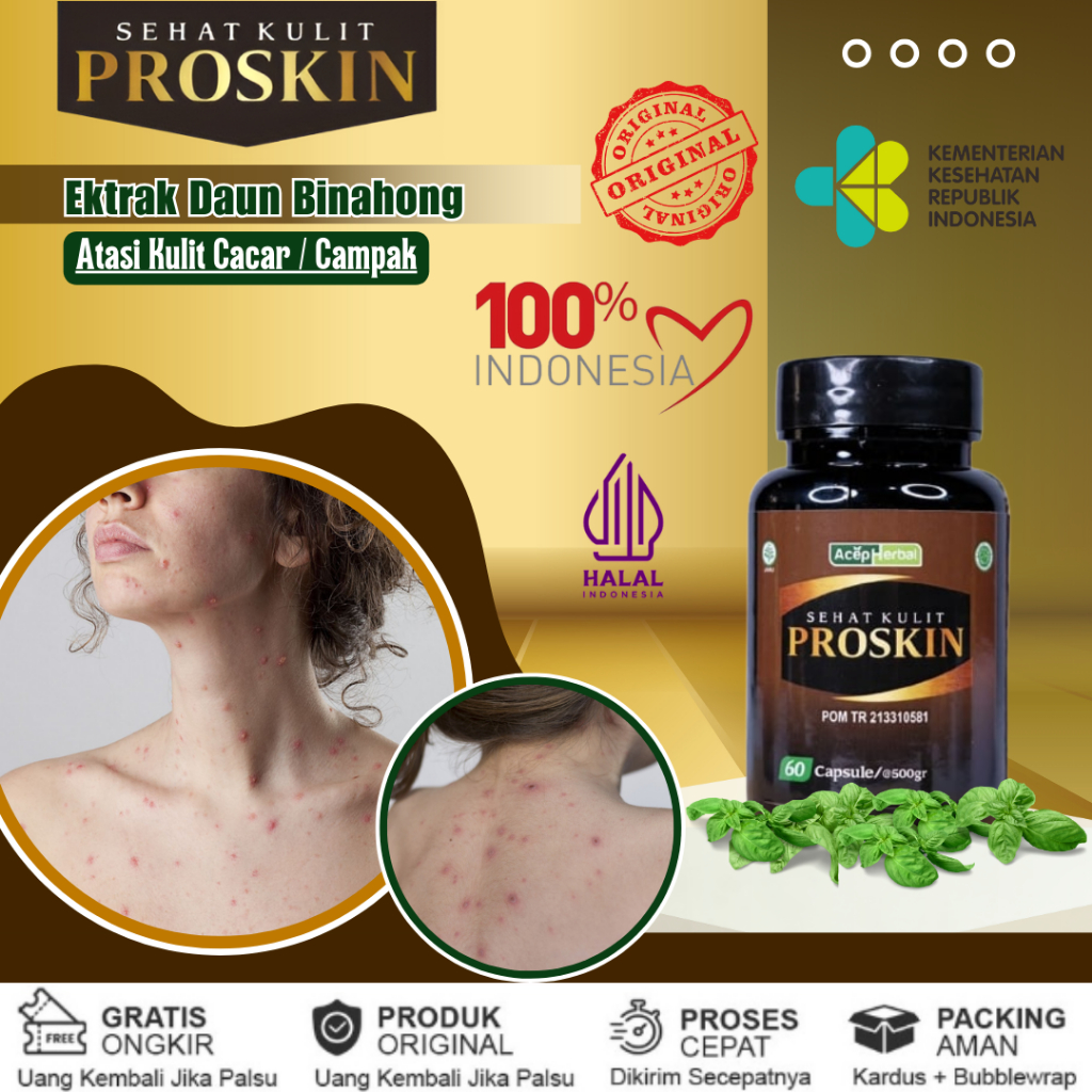 Obat Cacar, Obat Cacar Air, Cacar Api, Cacar Ular, Obat Cacar Monyet, Obat Penghilang Cacar, Obat Va