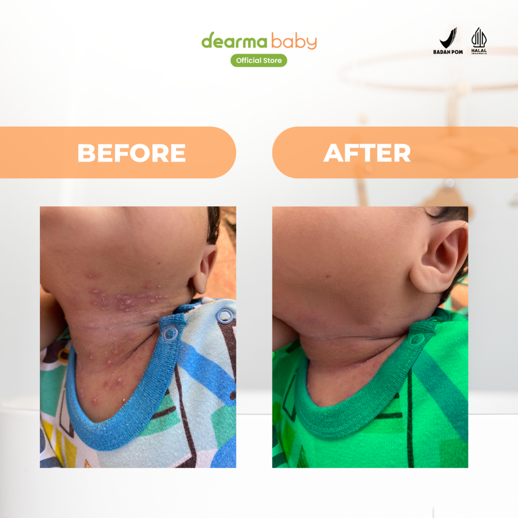 Baby Rash Protection Cream (Redakan Ruam Popok, Ruam Susu, Biang Keringat, Biduran) | Kandungan 18% 
