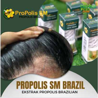 Obat Penghilang kulit kepala berkerak seperti ketombe, Salep Cair kulit kepala kering, psoriasis kul