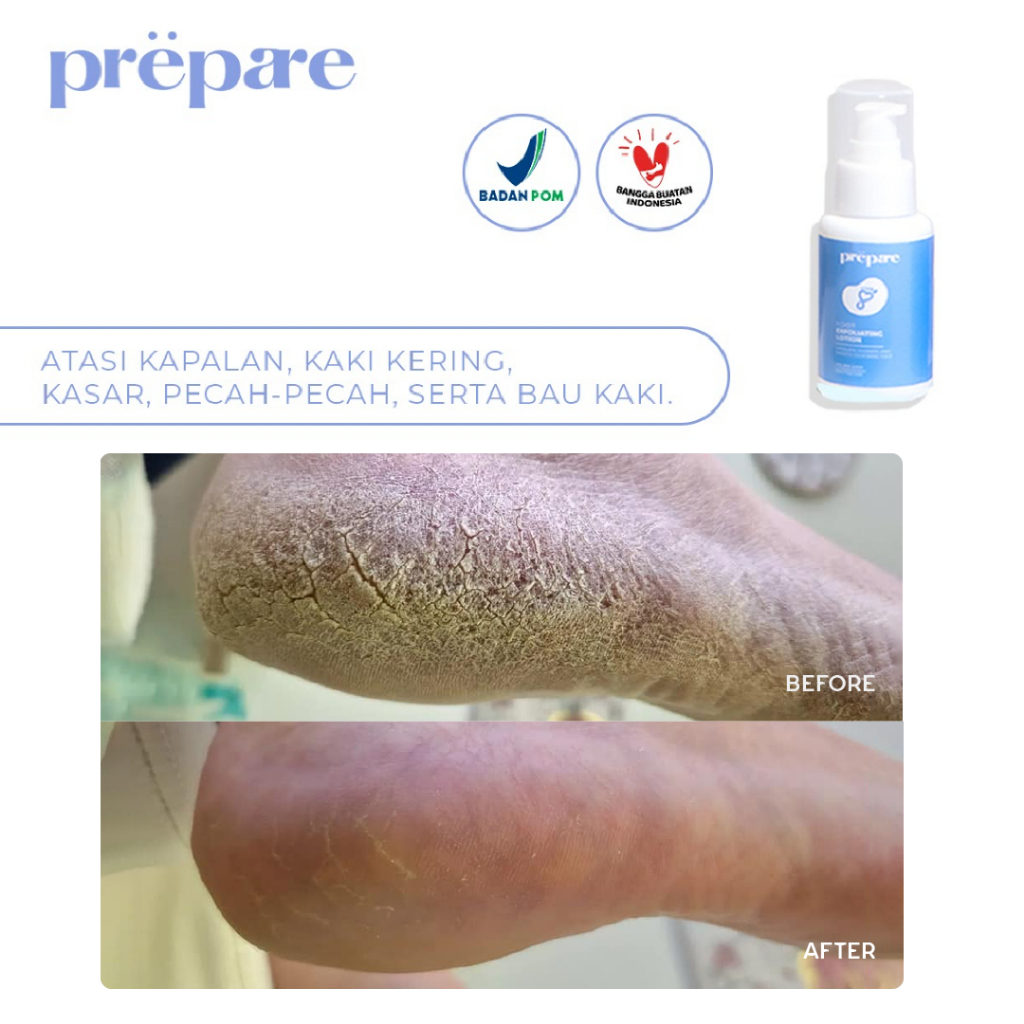 PREPARE Foot Care Penghalus Tumit Kaki Obat Kaki Pecah Pecah Penghalus Kaki Pecah dan Kering