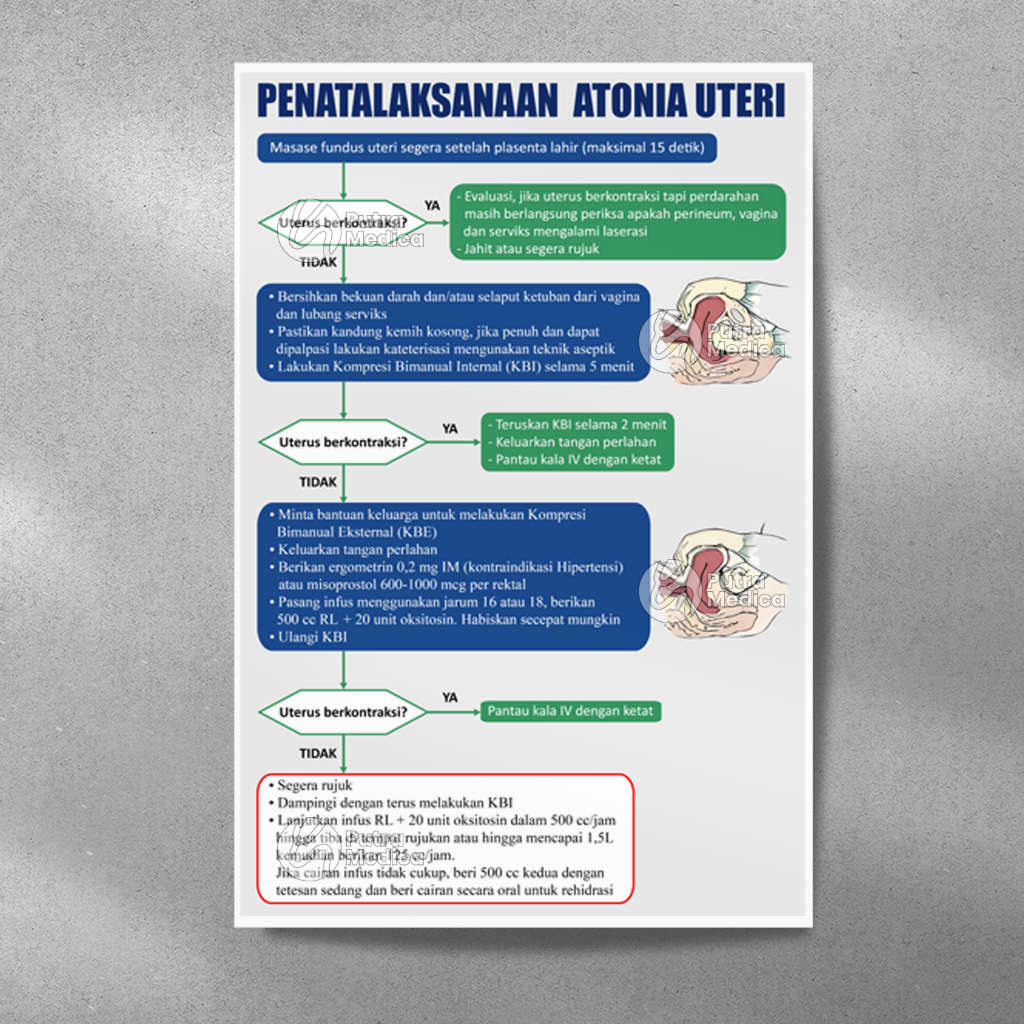 Poster Kesehatan Penatalaksanaan Atonia Uteri A3+ / Gambar Edukasi Kebidanan / Penanganan Melahirkan