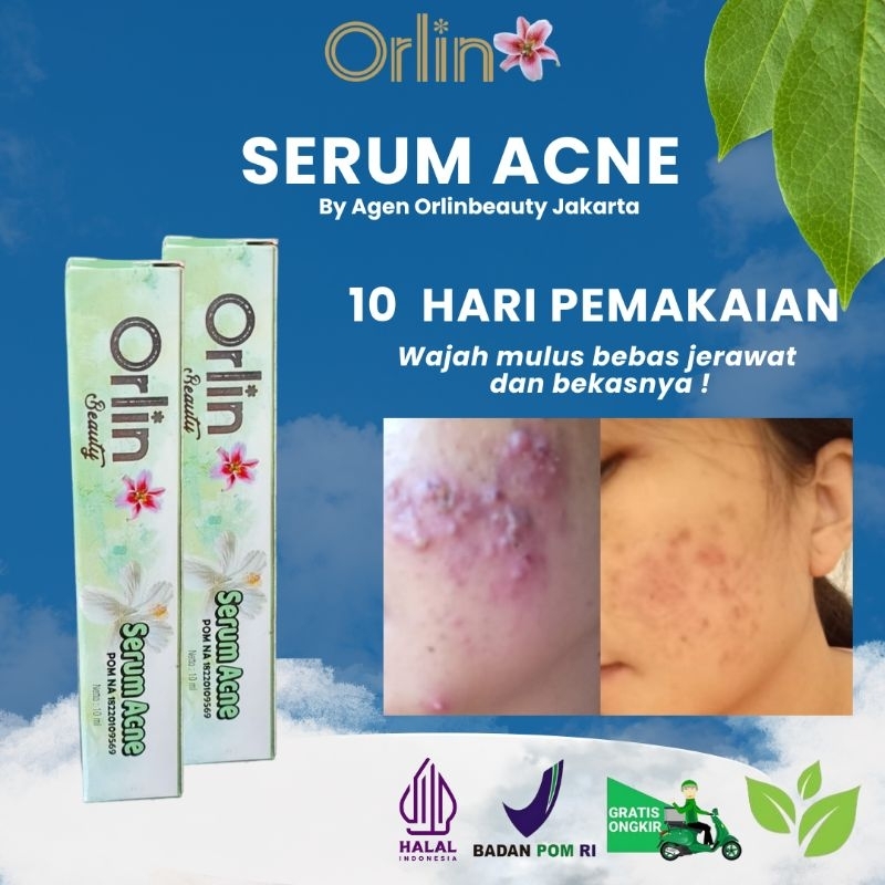 SERUM ACNE ORLIN BEAUTY
