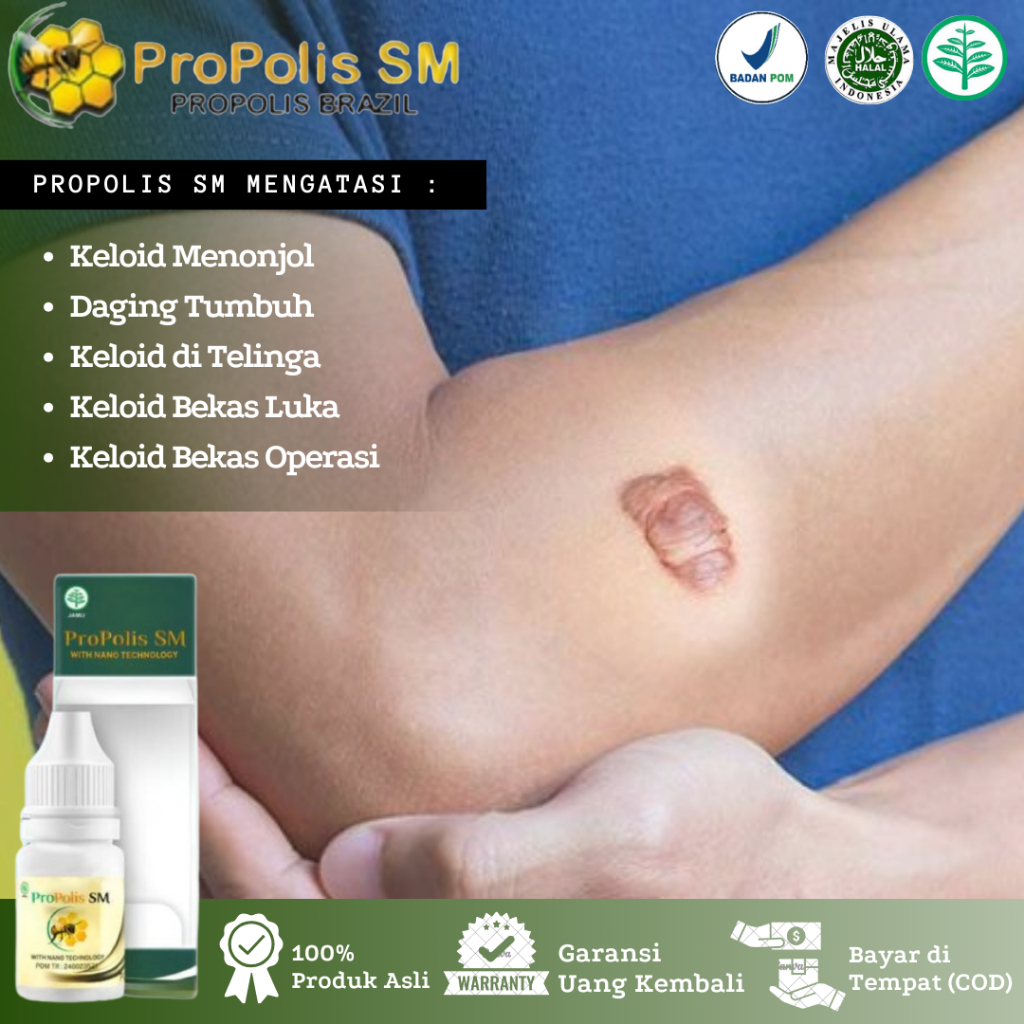 Obat Keloid Menonjol, Daging Tumbuh, Keloid Bekas Luka, Keloid di Dada, Keloid Bekas Operasi, Keloid
