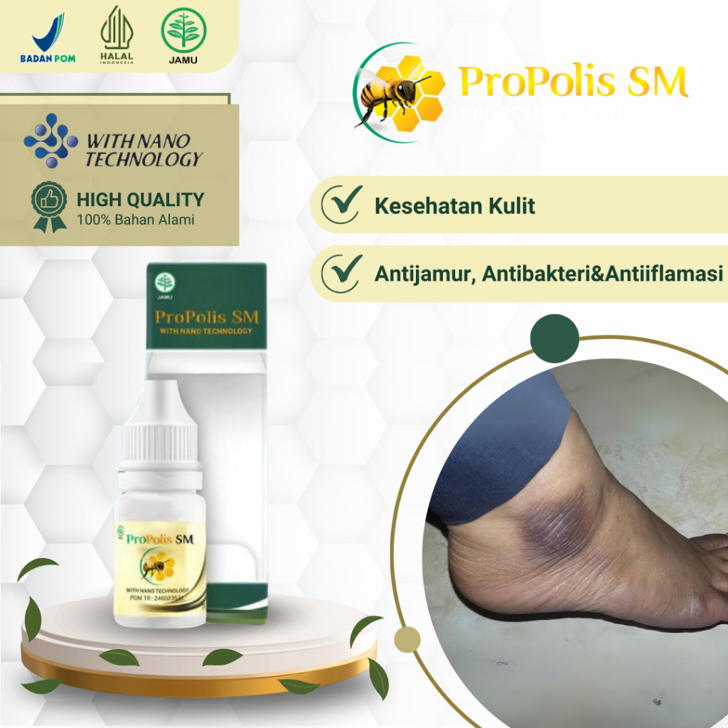Obat Mata Kaki Hitam Luka Lecet Karena Gesekan Sendal / Sepatu, Obat Pelembab Dan Pemutih Mata Kaki 