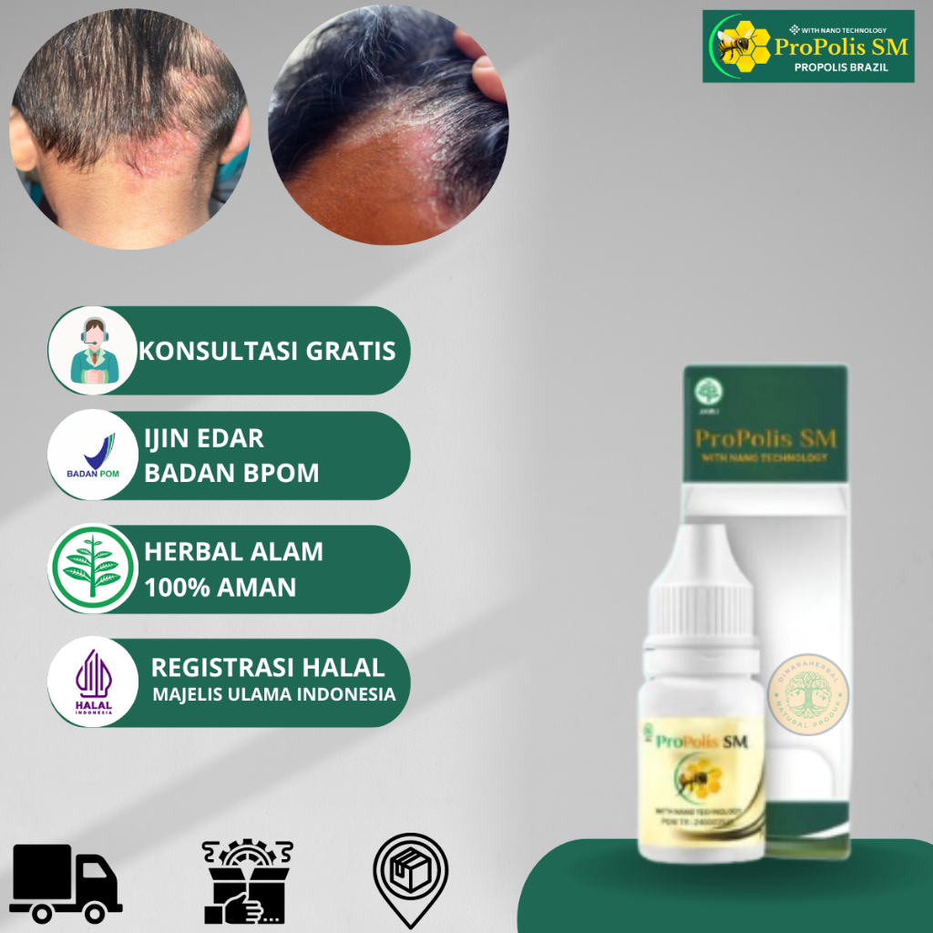 ProPolis SM Borok di Kulit Kepala Psoriasis Kulit Bersisik Kering Luka Obat Penghilang Ketombe Di Ke
