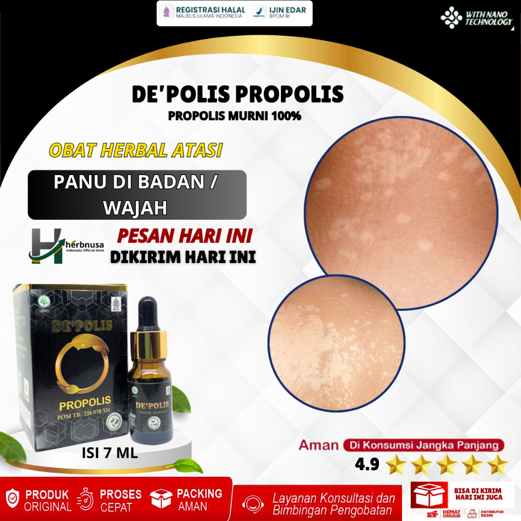 Obat Panu, Obat Panu Di Wajah, Penghilang Panu, Obat Panu Anak, Obat Hapur Kulit, Obat Bercak Putih 