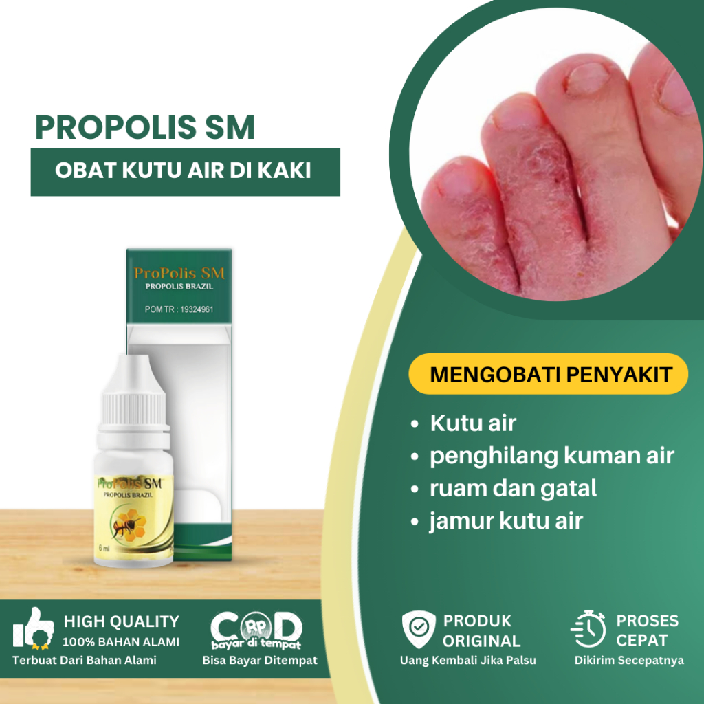 Obat Kutu Air Pada Kaki, Penghilang Kuman Air,  Jamur Kutu Air - Propolis SM