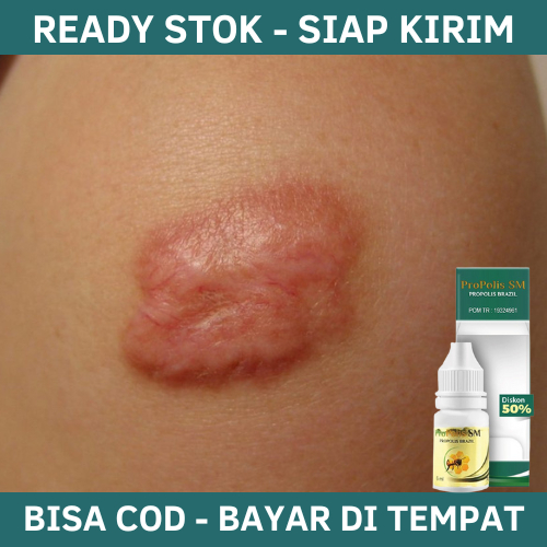 Obat Keloid, Obat Untuk Keloid, Obat Keloid Luka Tindik, Obat Keloid Daging Tumbuh, Obat Hilangkan K
