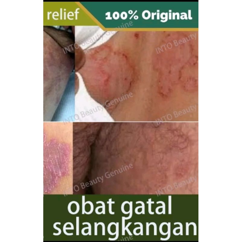 Salep Gatal Jamur / Salep Gatal Selangkangan