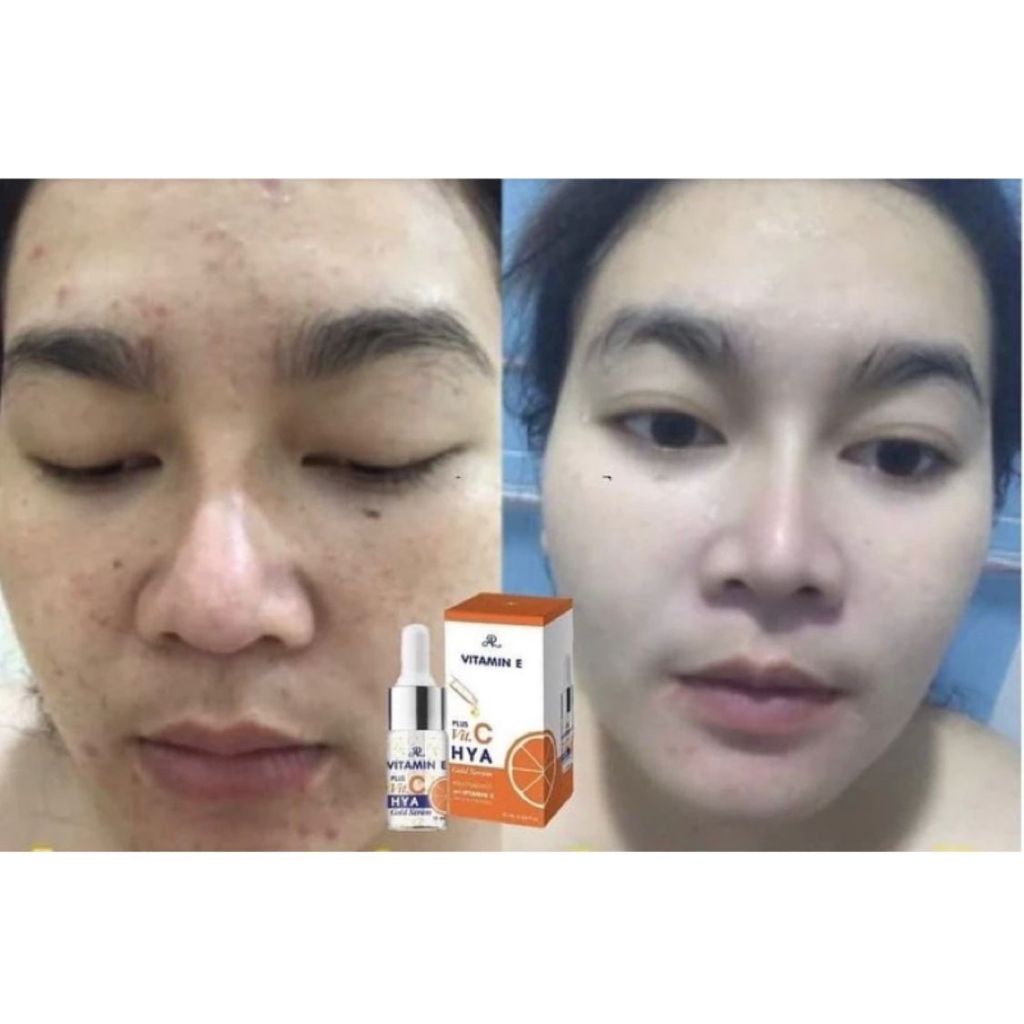 AR Serum Vitamin E,C, dan Hyalu Gold Serum