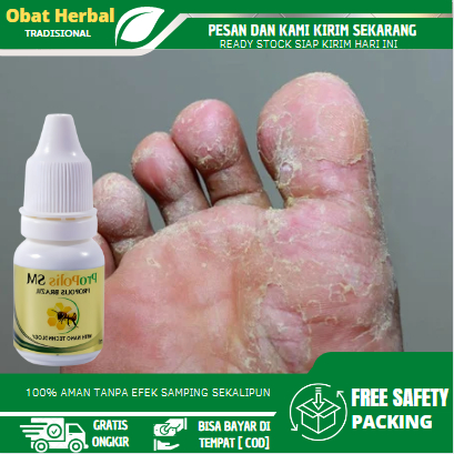 Obat Kutu Air Di Kaki, Penghilang Kuman Air, Obat Gatal Gatal Kaki, Obat Kutu Air di Sela Jari, Obat