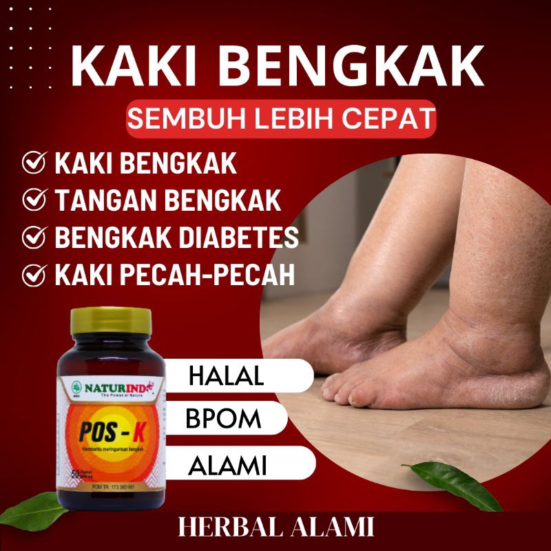 Obat Kaki Bengkak Pecah-Pecah Bengkak Asam Urat Jantung Bengkak paling Ampuh
