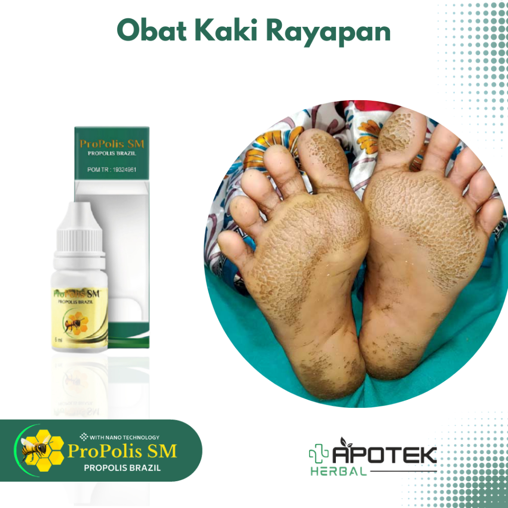 Obat Kaki Rayapan Rangen Kaki Obat Kaki Berlubang Pecah Pecah Obat Kaki Jamuran Obat Kaki Kapalan Ob