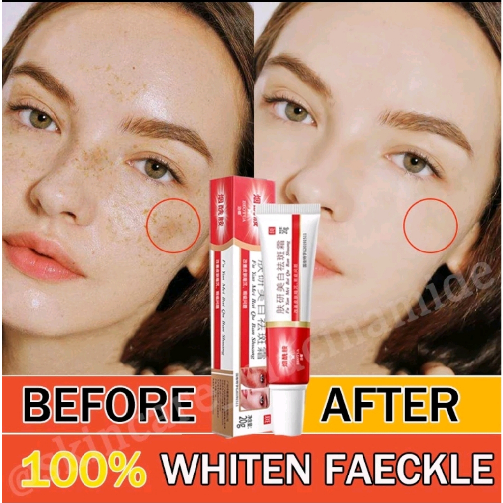 NIACINAMIDE SALEP FLEK HITAM MELASMA MEMBANDEL 100% original cream fu yan mei bai qu ban shuang 20 m