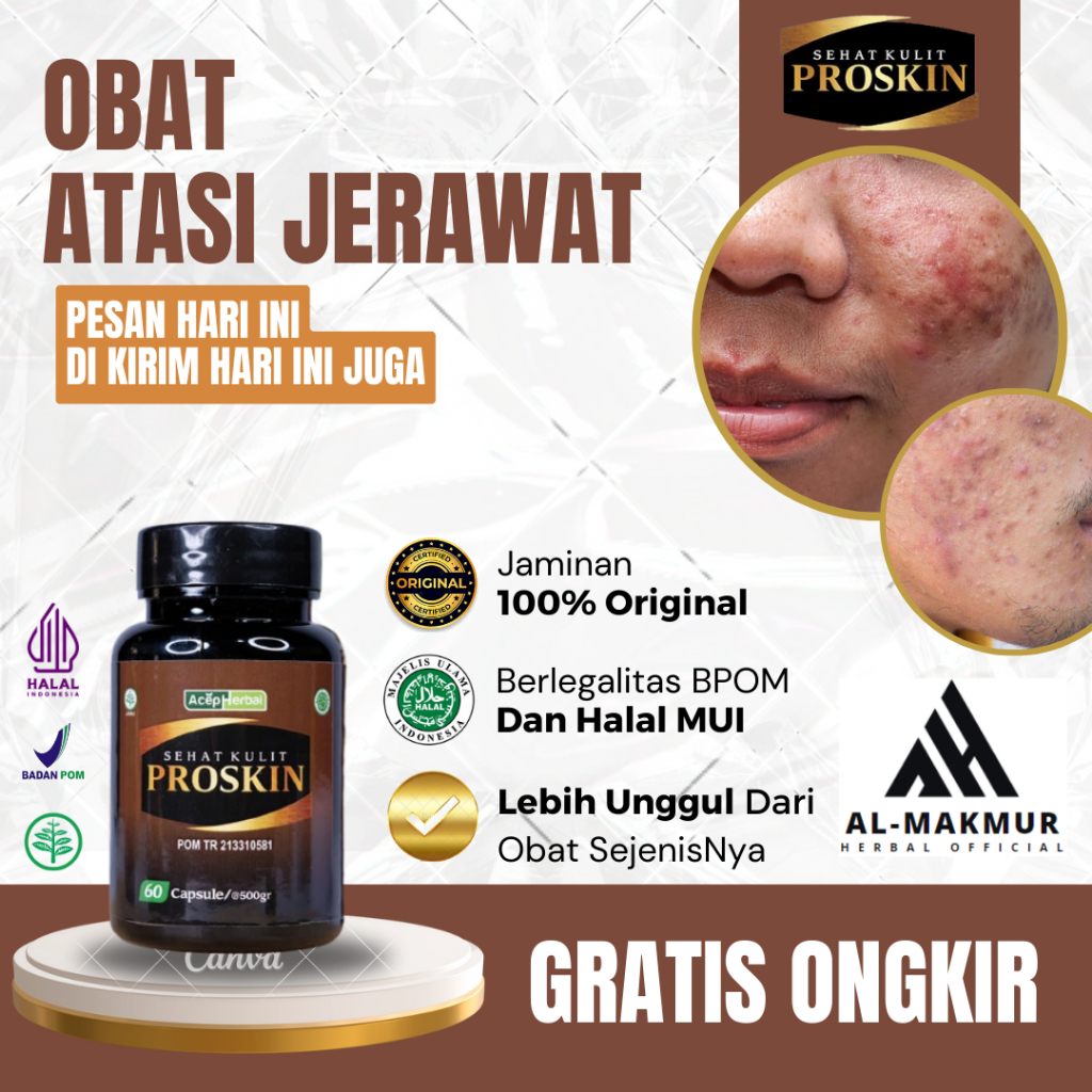 Obat Jerawat Di Wajah, Obat Bopeng Berlubang Di Wajah, Obat Berminyak Untuk Wanita Dan Pria Remaja, 
