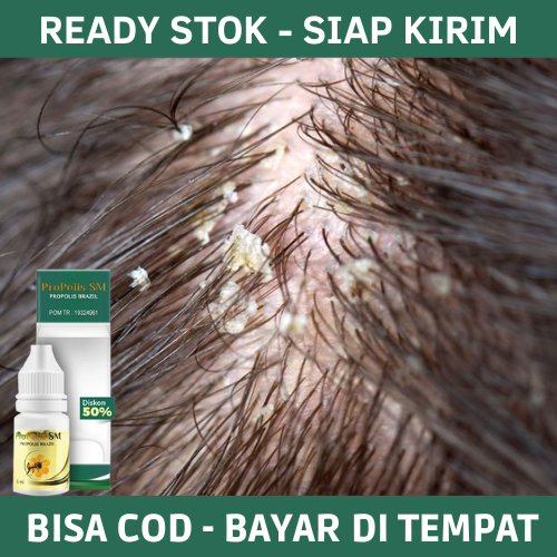 Obat Ketombe, Obat Ketombe Kerak Kulit Kepala, Obat Ketombe Berkerak di Kepala, Obat Ketombe Parah, 