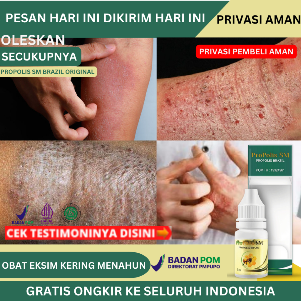 Obat Eksim Kering Menahun, Obat Gatal Kulit Eksim, Obat Eksim Basah, Obat Gatal Eksim, Obat Kulit Ga