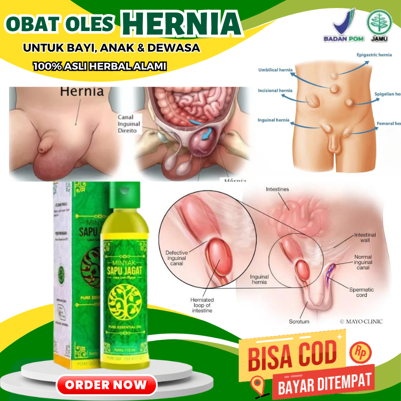 Obat Oles Hernia Untuk Bayi, Hernia Pada Anak, Obat Hernia Umbilikalis, Hernia Inguinalis, Minyak Ol