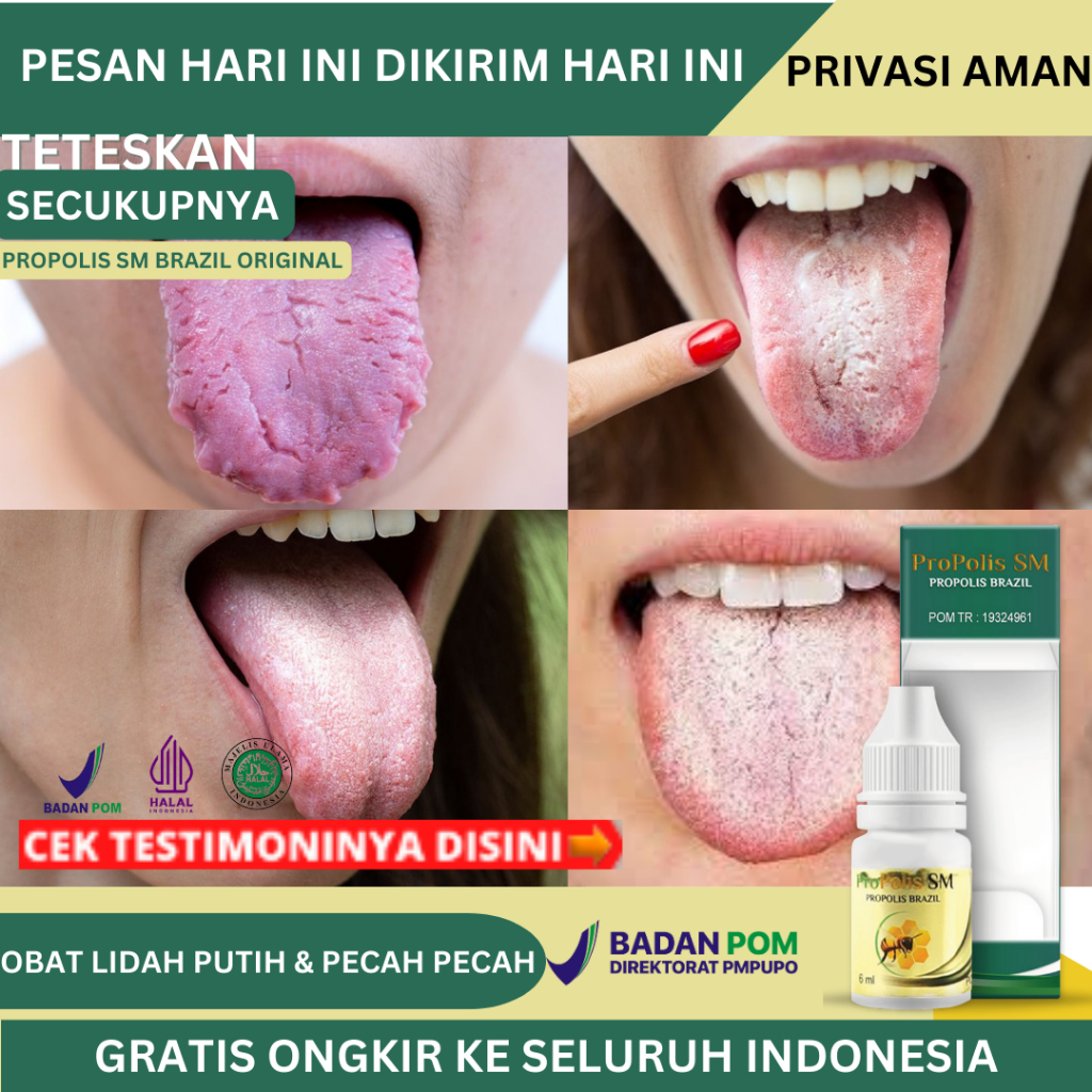 Obat Lidah Pecah Pecah, Obat Lidah Putih Obat Lidah Sariawan, Obat Lidah Putih Berjamur, Obat Lidah 