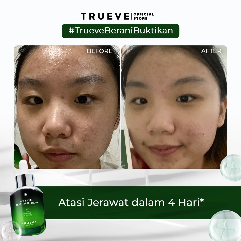 Trueve Acne Treatment Combo (Acne Care Treatment Serum &amp; Peeling Serum)