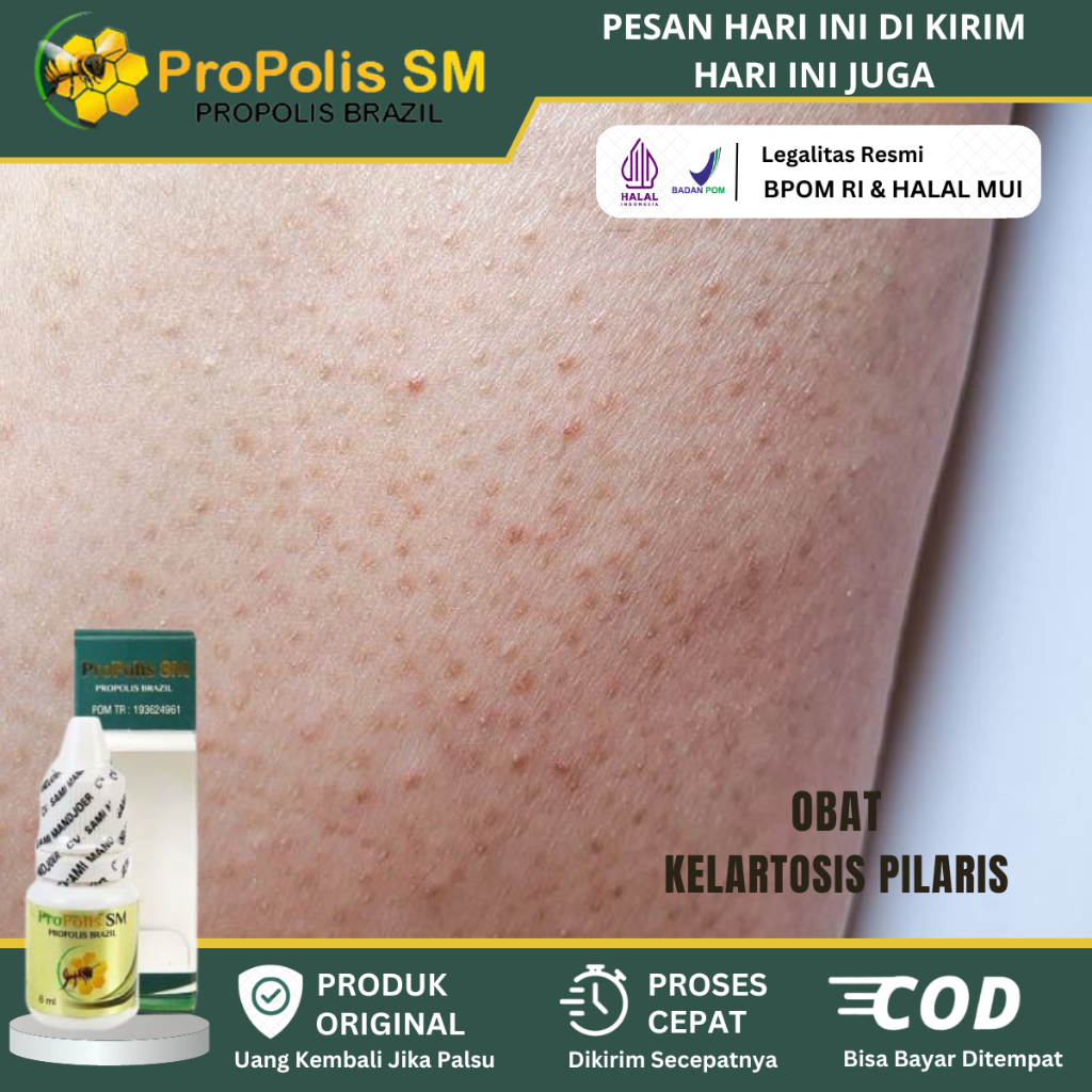 Obat Salep Bintik Hitam Di Kulit, Obat Bintik-Bintik Berwarna Merah, Obat Kulit Ayam, Obat Herpes Ge