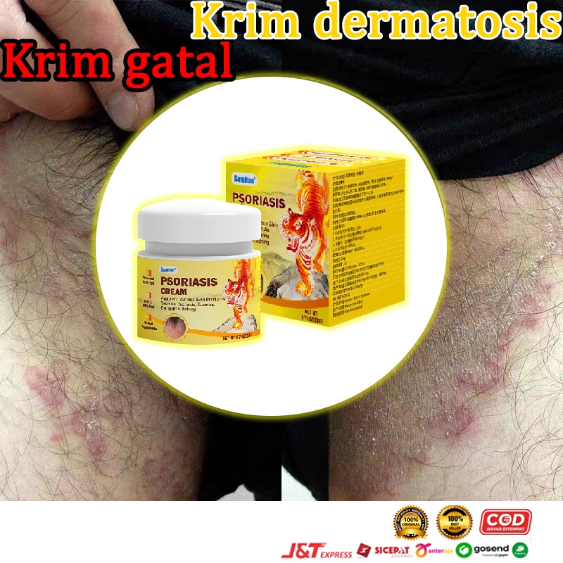 salep jamur kulit salep eksim salep gatal paling ampuh salep gatal 20g Kulit Kepala Psoriasis Tangan