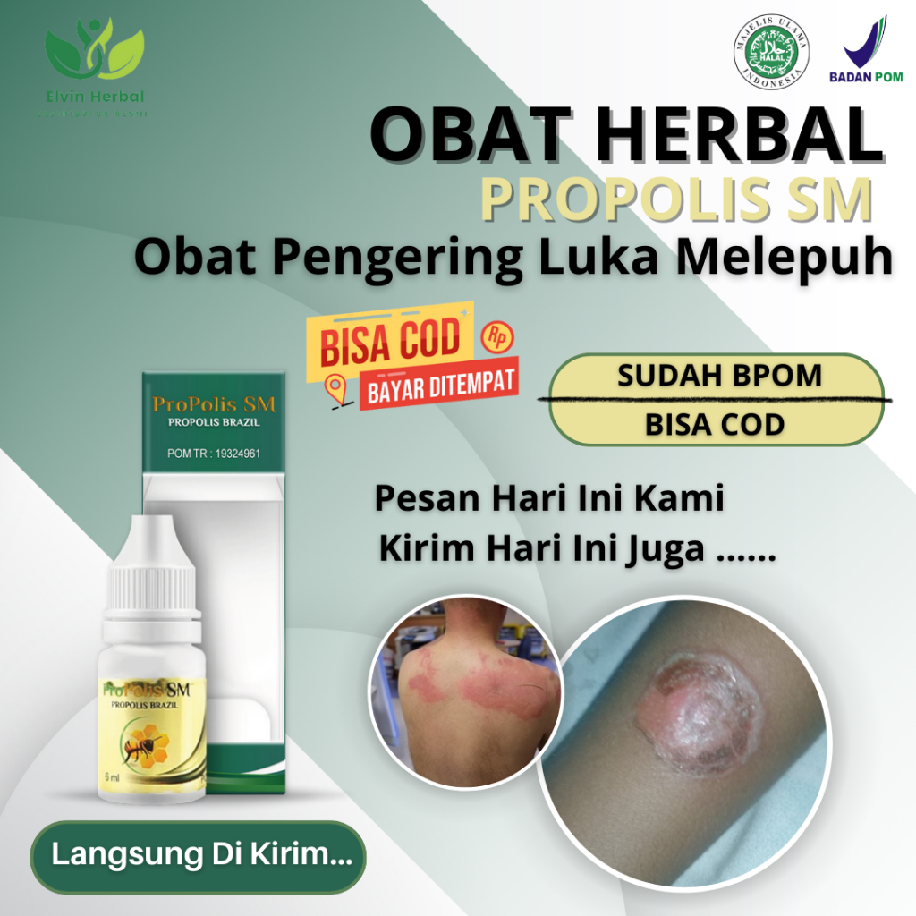 Obat Untuk Luka Knalpot, Obat Luka Akibat Terkena Kenalpot, Luka Bakar Akibat Minyak Panas, Obat Pen