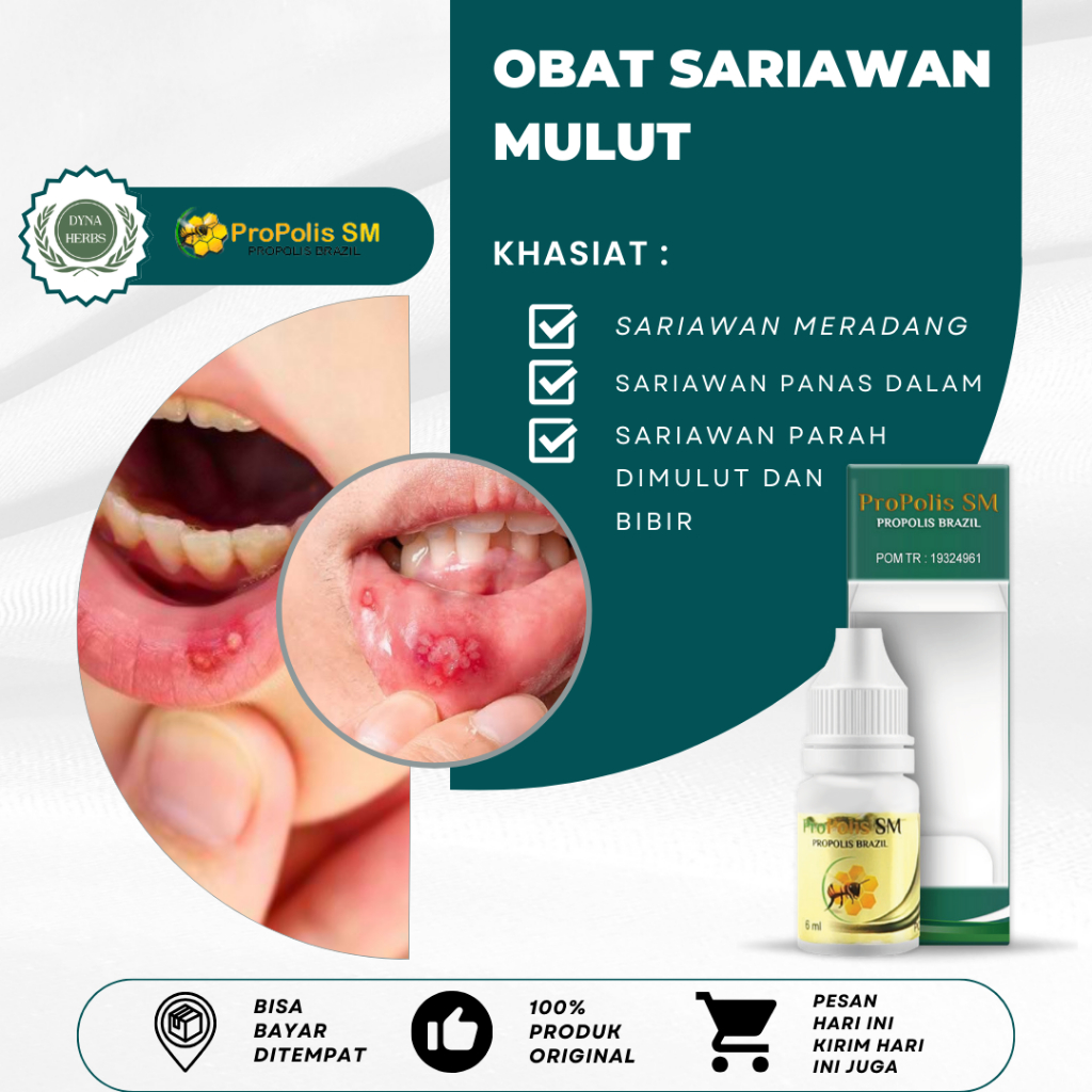 Obat Sariawan Di Bibir, Obat Sariawan Di Bibir Mulut, Obat Sariawan di Lidah, Obat Sariawan di Gusi,