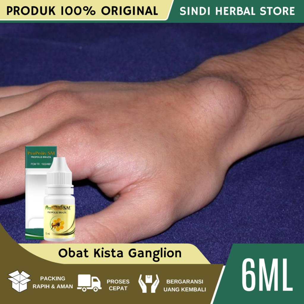 Obat Kista Ganglion, Obat Kista Ganglion di Tangan, Obat Penghancur Kista Ganglion, Obat Penghilang 