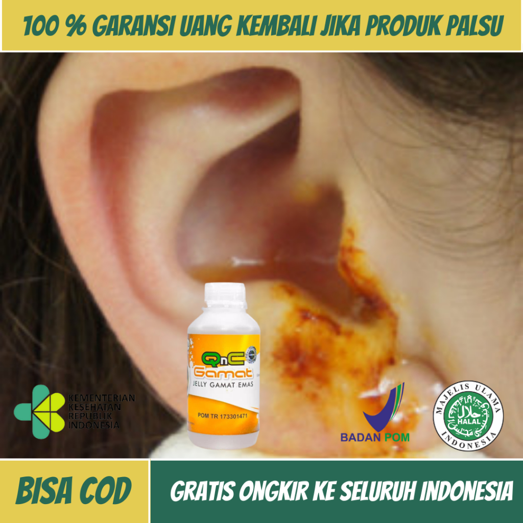 Obat Sakit Telinga, Obat Telinga Berair, Obat Congek Menahun, Obat Gendang Telinga Bocor, Obat Telin