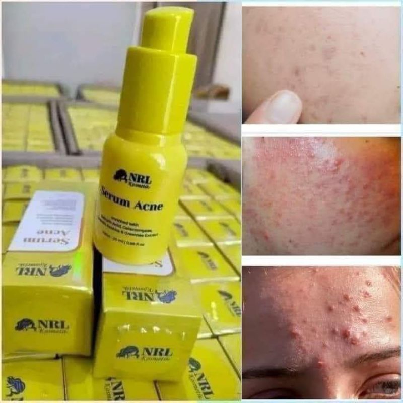 NRL KOSMETIK SERUM ACNE 100 % ORI