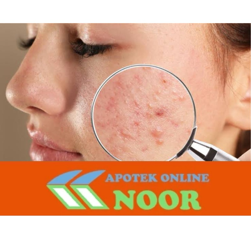 OBAT JERAWAT BATU/MERADANG/BERUNTUSAN AMPUH 100%