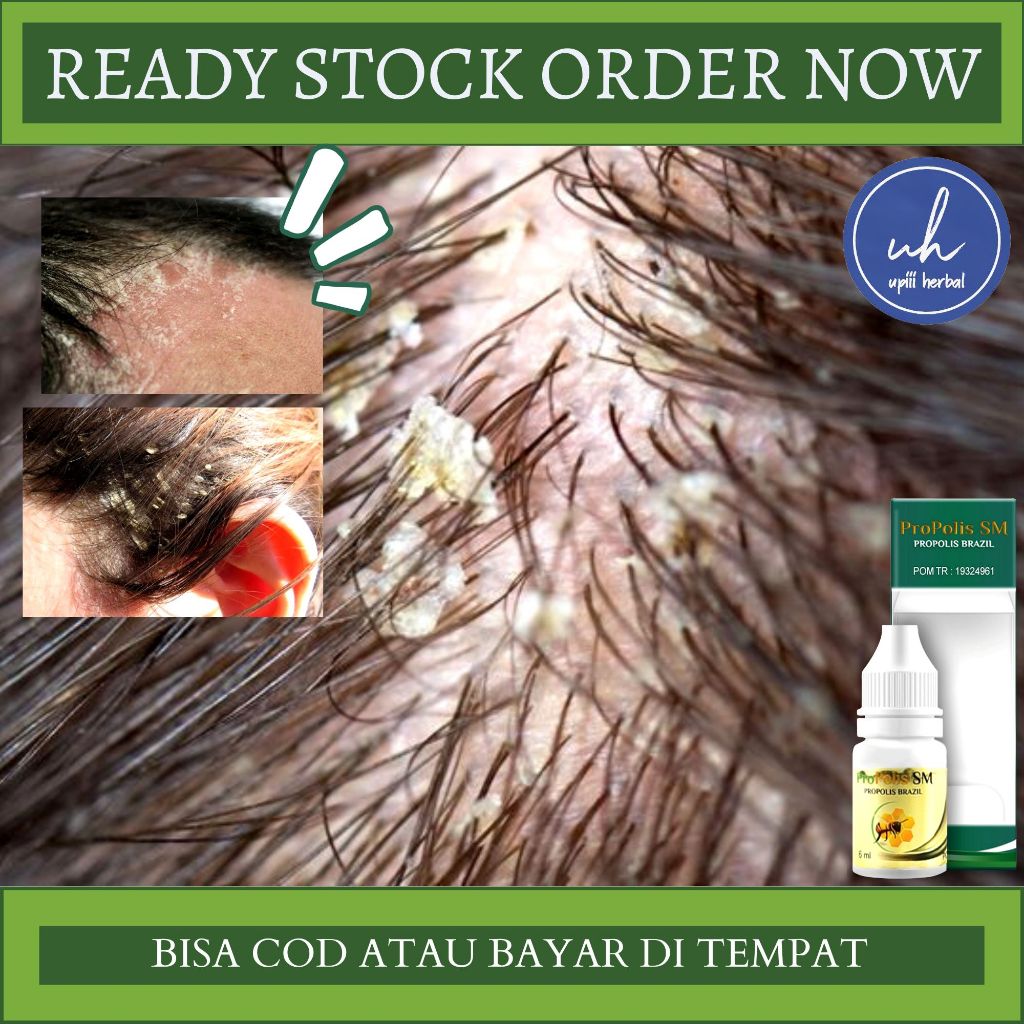 Obat Ketombe Berkerak, Obat Kulit Kepala Berkerak, Obat Gatal Kepala, Obat Jamur Kepala, Obat Psoria