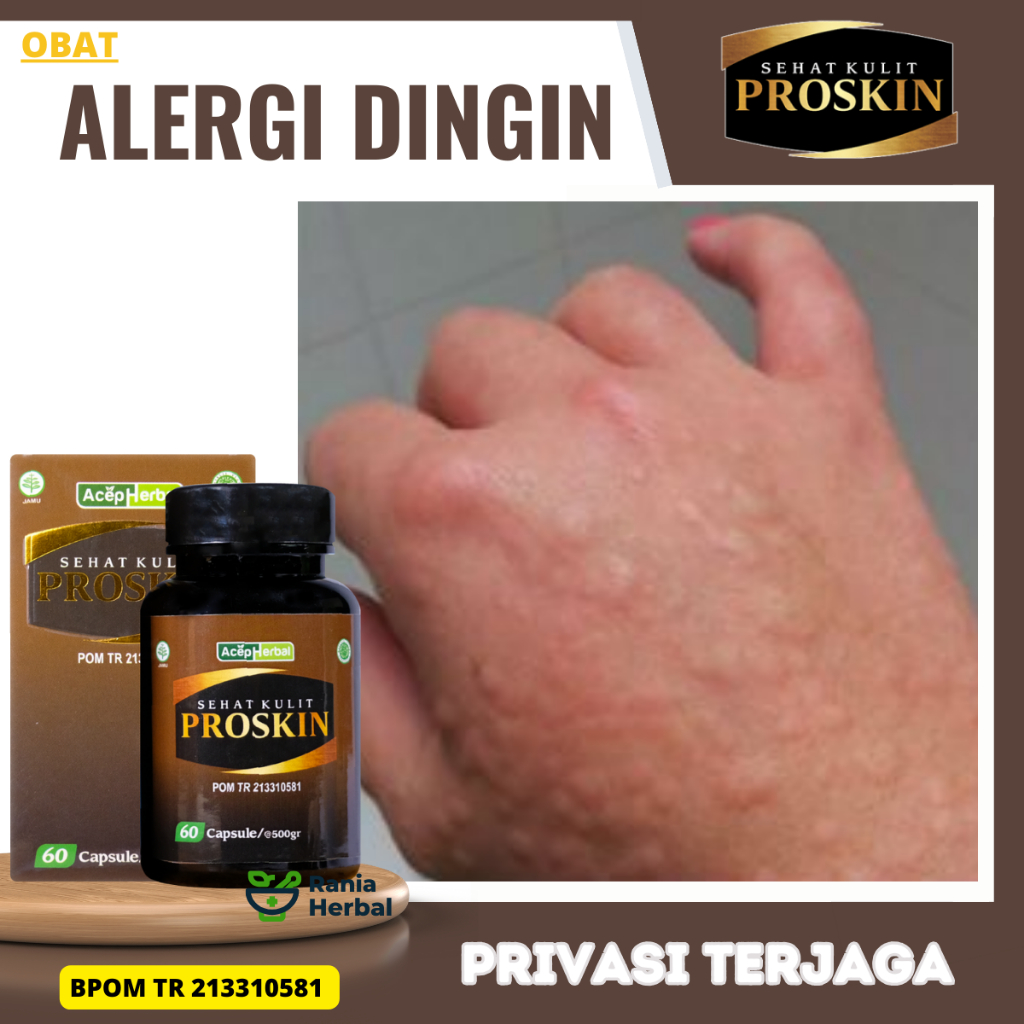 PROSKIN - Obat Alergi Dingin, Obat Gatal Alergi Dingin, Penghilang Bentol Gatal, Obat Tampek, Obat A