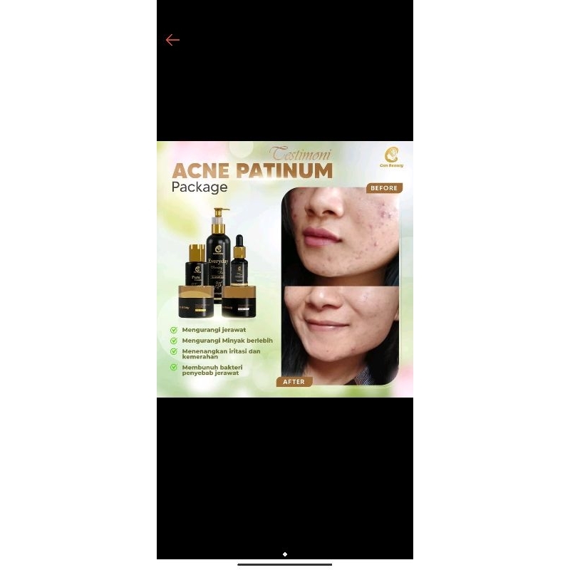 Paket acne can beauty