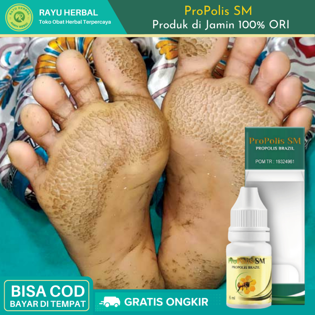 Obat Telapak Kaki Bolong Bolong Kecil, Obat Penghilang Bolong Bolong Kecil di Telapak Kaki, Obat Kak