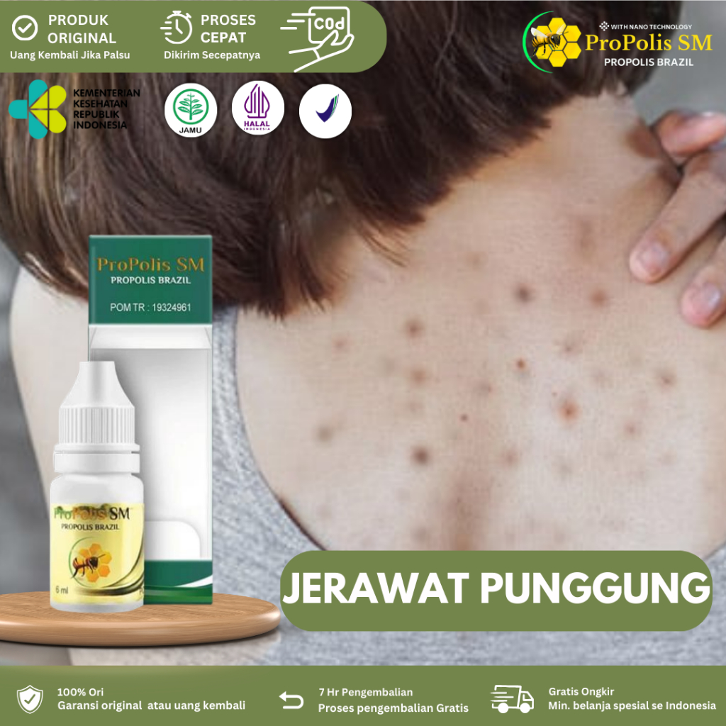 Obat Jerawat punggung dan dada, Penghilang Jerawat Batu Salep Jerawat punggung, Obat jerawat badan, 