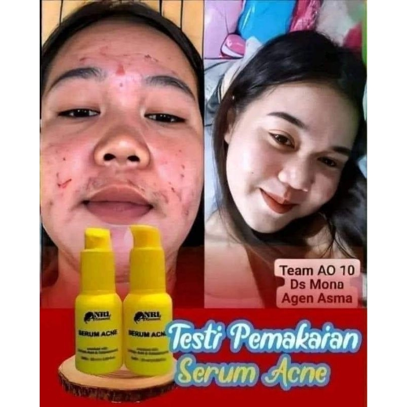 NRL Serum acne BPOM by NRL kosmetik